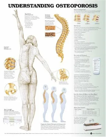Wolters Kluwer Health - 9781496362483 - Anatomical Chart Understanding Osteoporosis 20 X 26 Inch Plastic Grommets Laminated